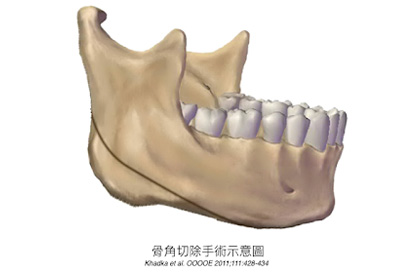 骨角切除手術示意圖