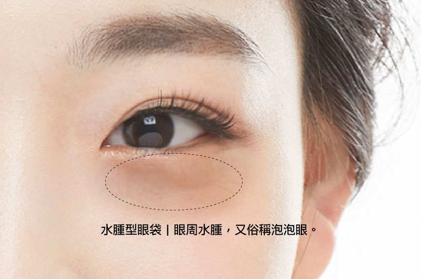 一張有著水腫型眼袋，又稱泡泡眼的眼部特寫照片