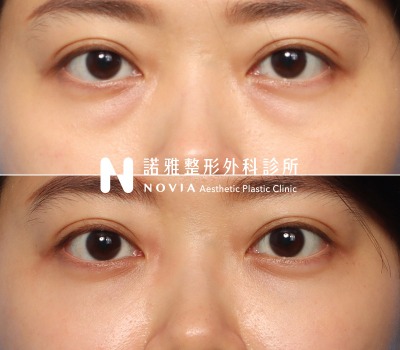 諾雅整形外科診所眼袋手術案例照