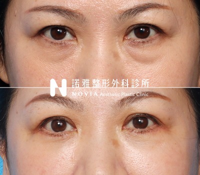 諾雅整形外科診所眼袋手術案例照