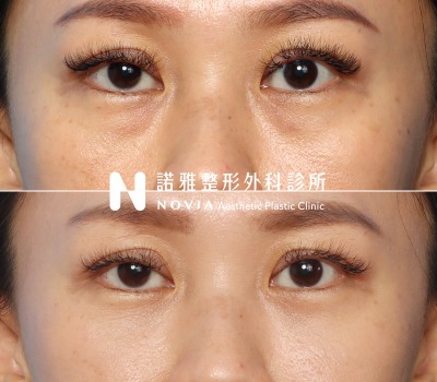 諾雅整形外科診所眼袋手術案例照
