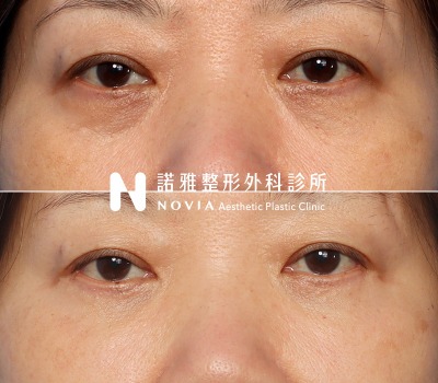 諾雅整形外科診所眼袋手術案例照