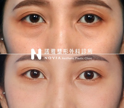 諾雅整形外科診所眼袋手術案例照