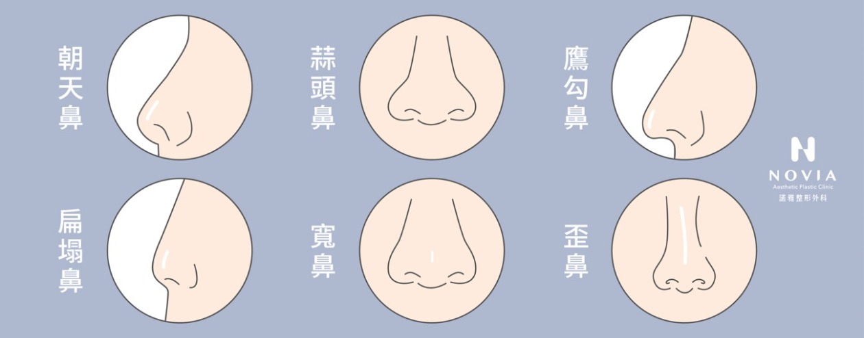 適合隆鼻的常見不理想鼻型