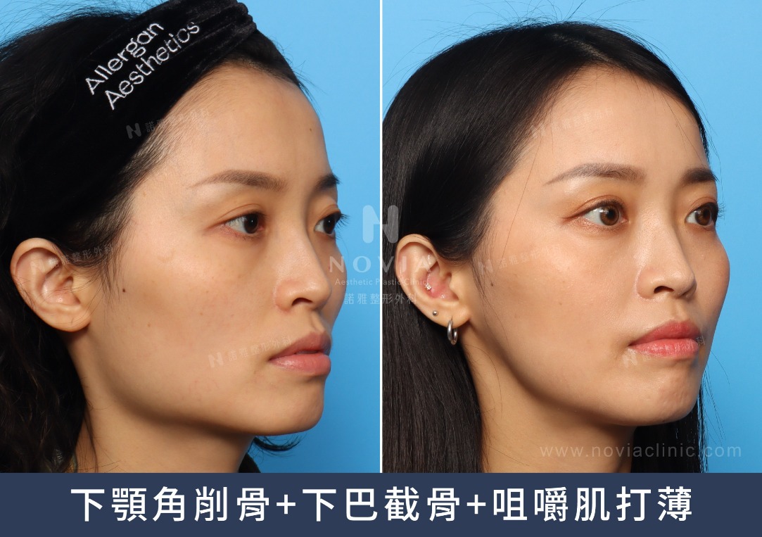 下顎角削骨手術案例
