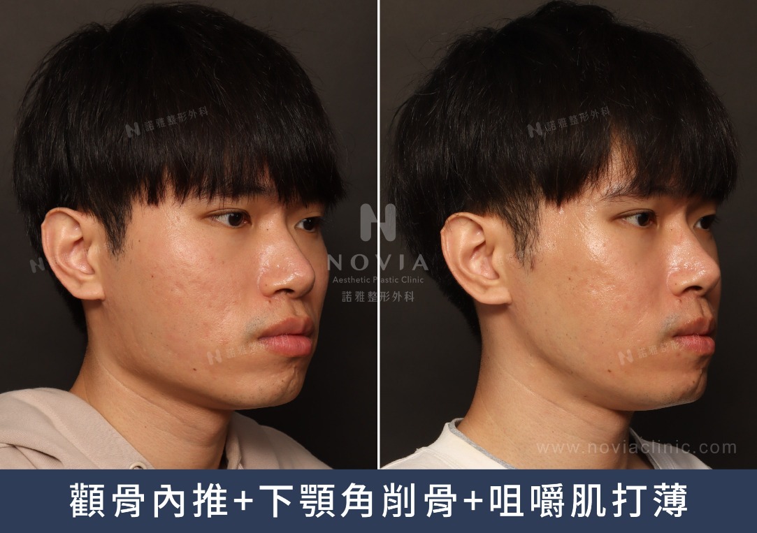 削骨手術案例