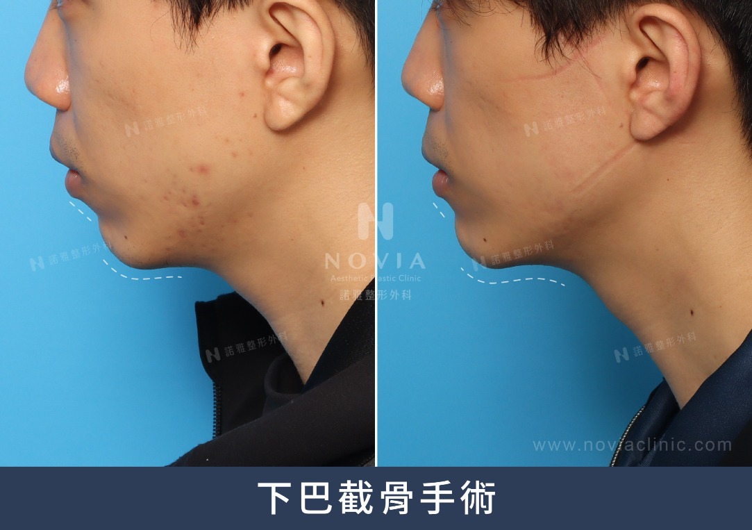 下巴截骨手術案例