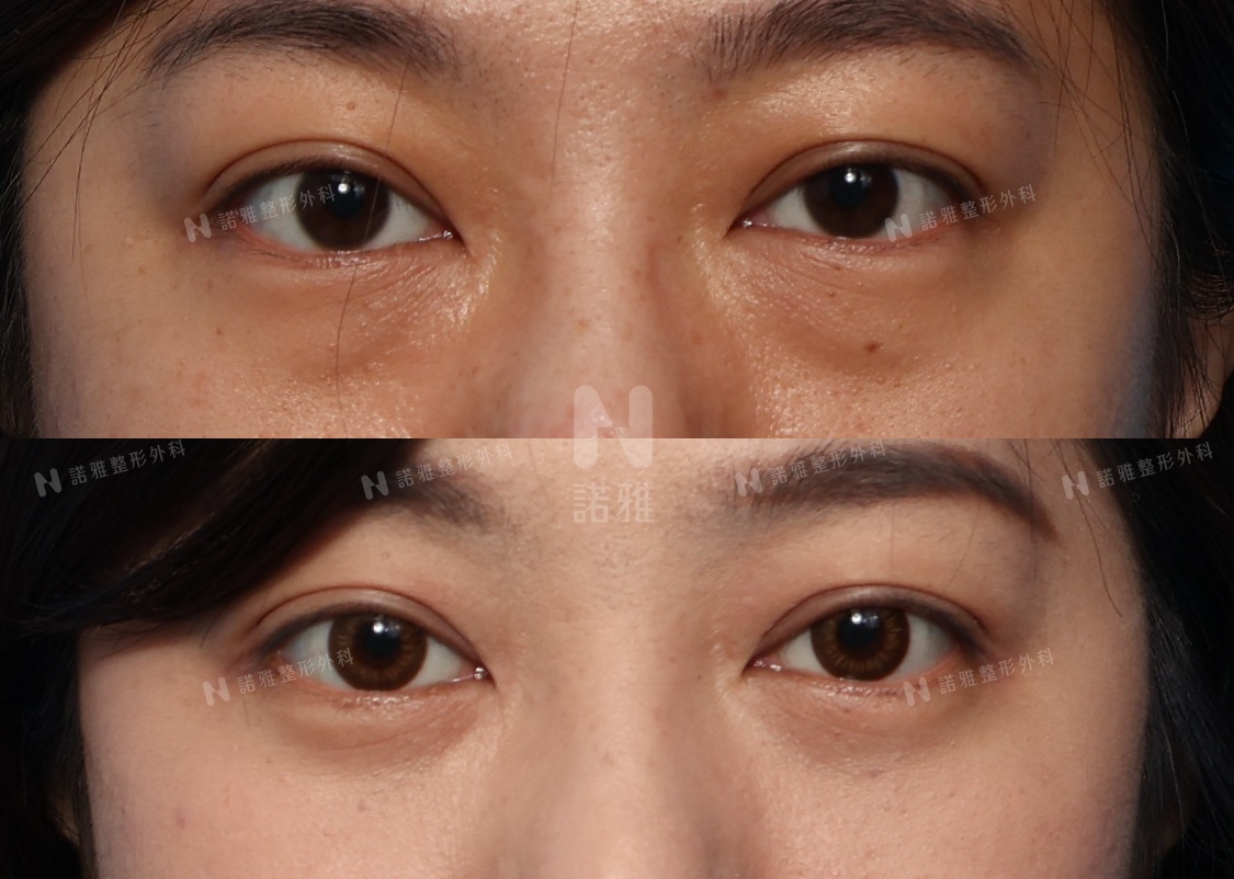 諾雅整形外科診所眼袋手術案例照