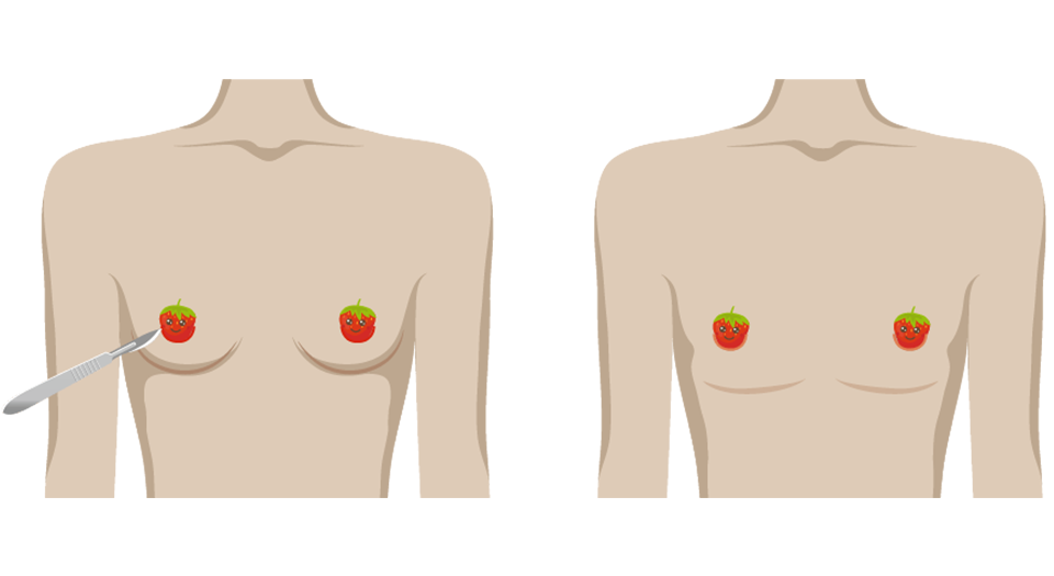 平胸手術的手術方式？乳暈微創平胸手術