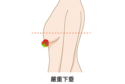 嚴重下垂適合的手術