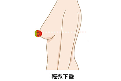 輕度下垂適合的手術