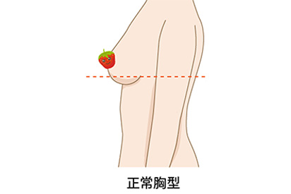 正常胸型適合的手術