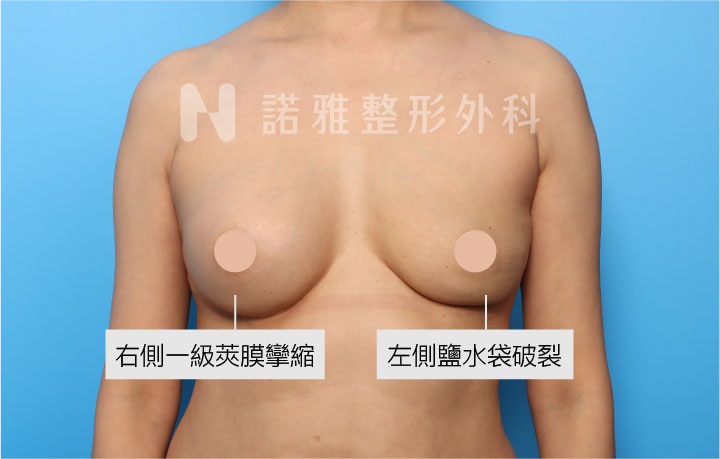 二次隆乳術前情況