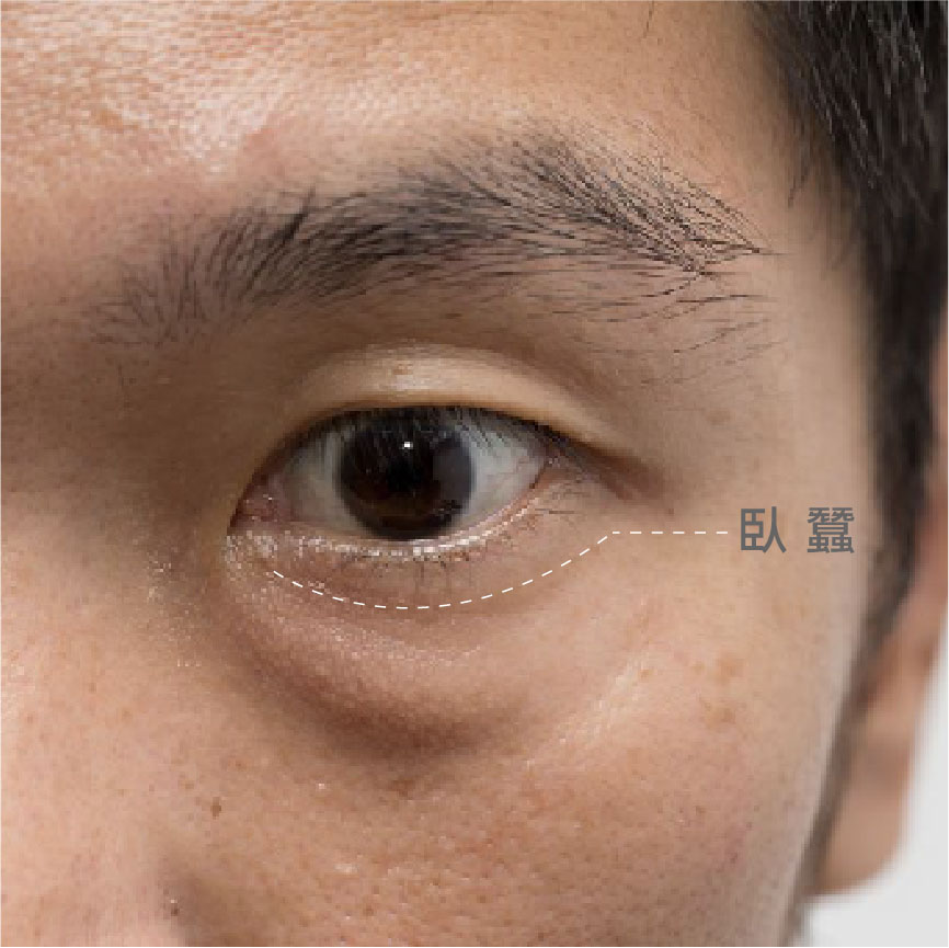 眼袋、淚溝、臥蠶怎麼分?臥蠶是什麼？