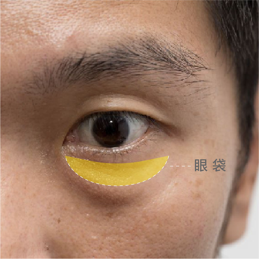 眼袋、淚溝、臥蠶怎麼分?眼袋是什麼？