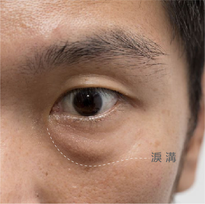 眼袋、淚溝、臥蠶怎麼分?淚溝是什麼？