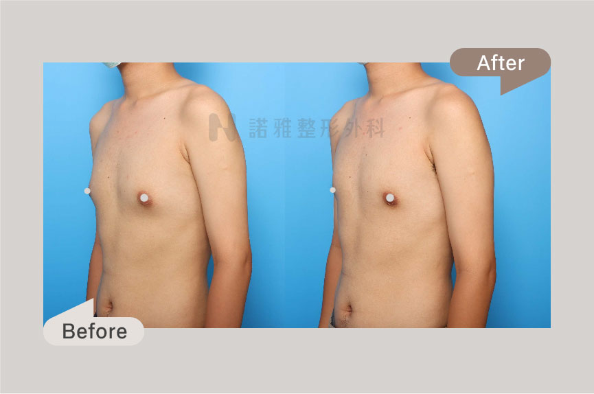 超微創複合式男性女乳手術案例