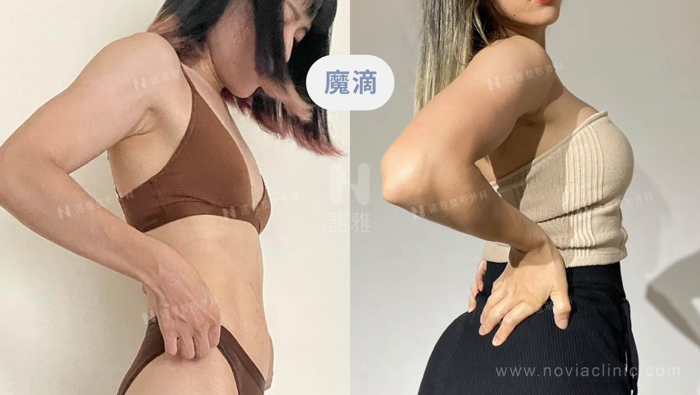 隆乳手術案例-魔滴隆乳術前術後比較