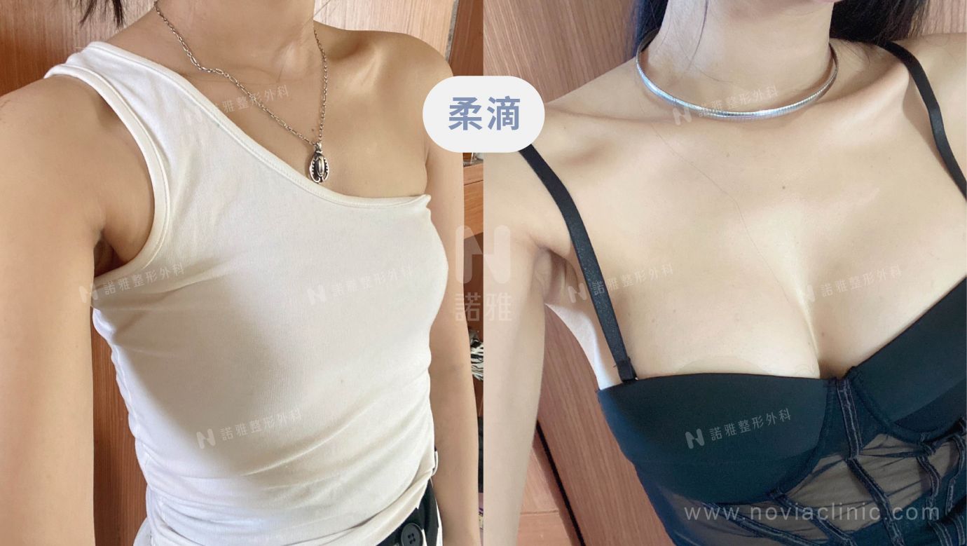 隆乳手術案例-柔滴隆乳手術術前術後比較