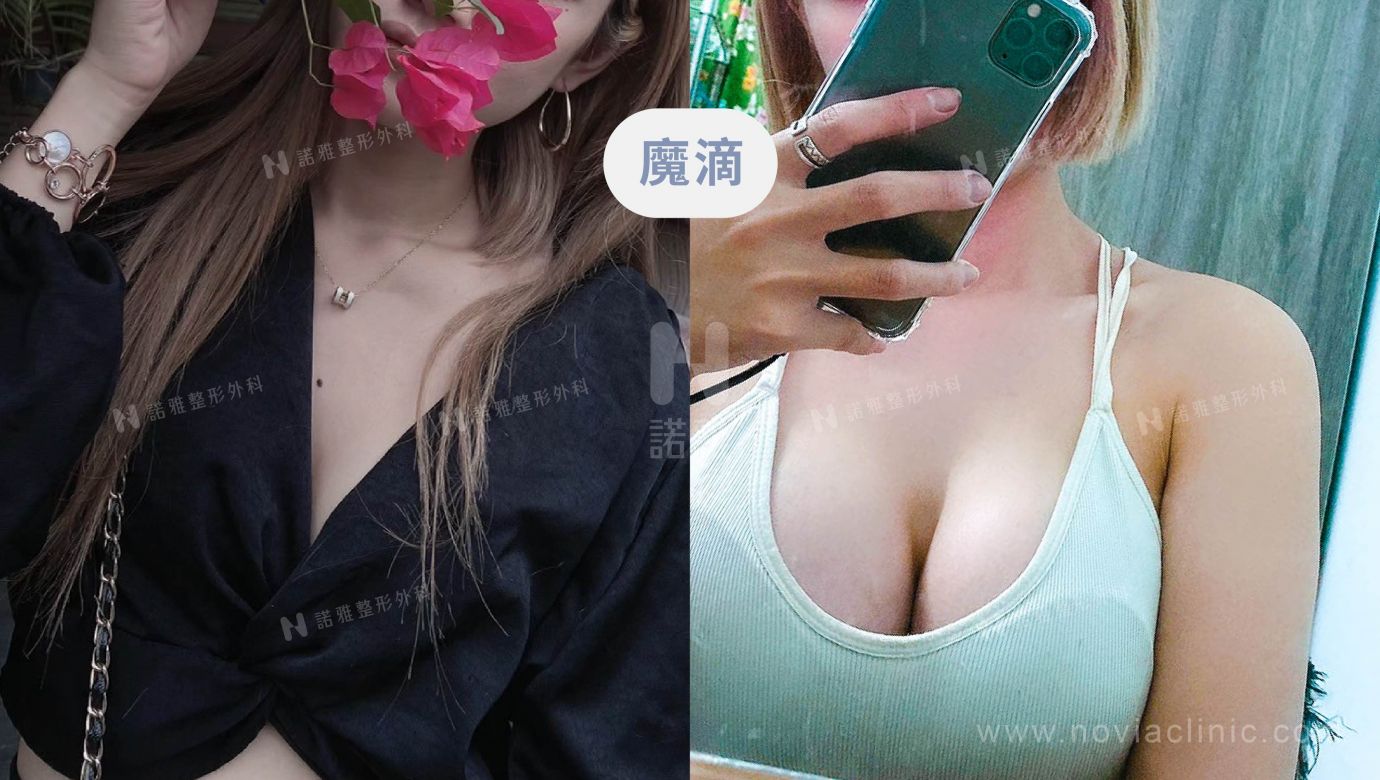 隆乳手術案例-魔滴術前術後對比