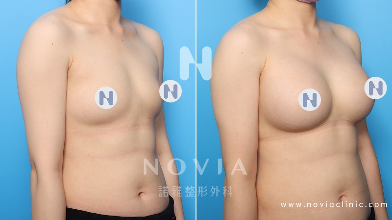 隆乳手術案例-術前與術後照片對比