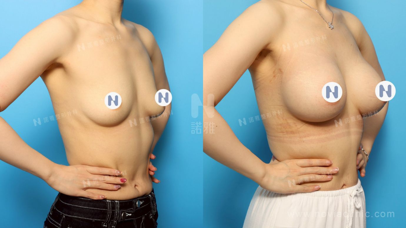 隆乳手術案例-手術後效果展示比較