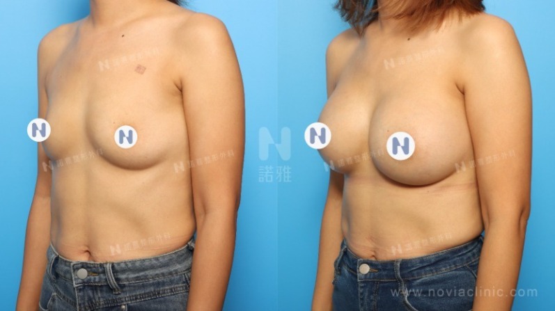 隆乳手術案例-隆乳術前術後外觀比較