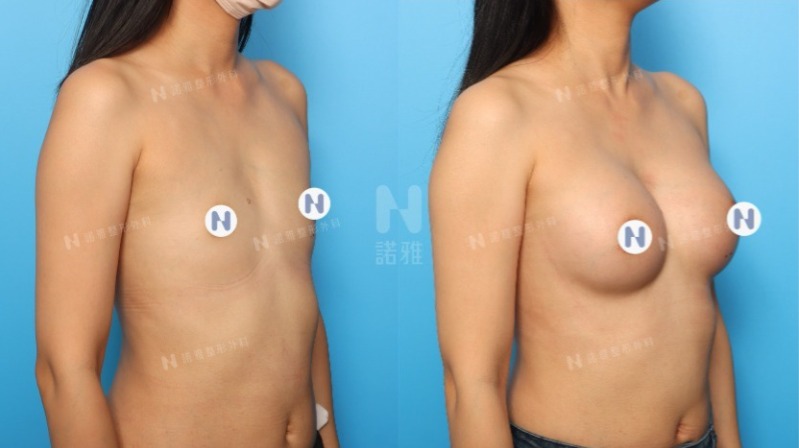 隆乳手術案例-隆乳手術前後外觀變化圖