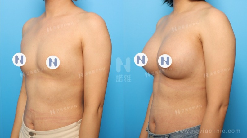 隆乳手術案例-隆乳後外觀變化圖
