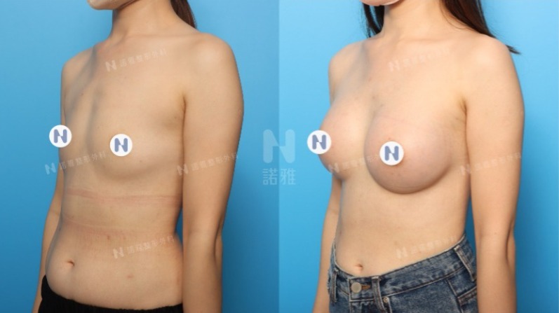 隆乳手術案例-隆乳術後結果對比
