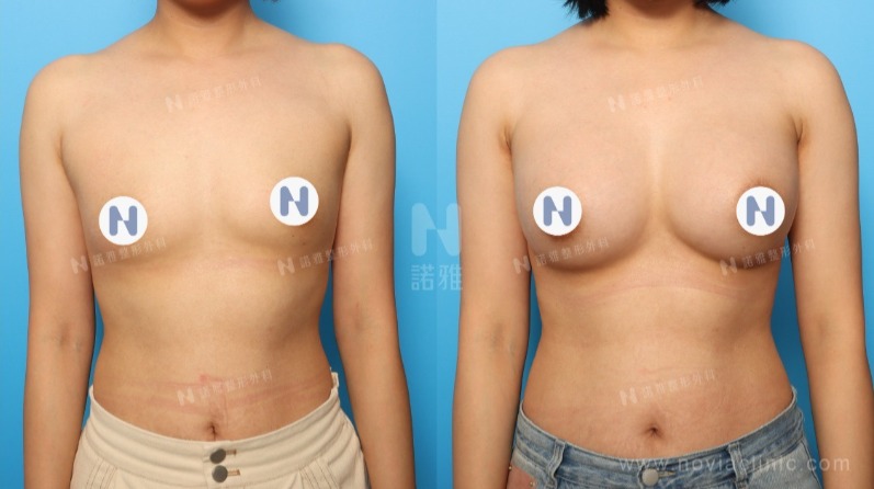 隆乳手術案例-隆乳前後變化差異對比