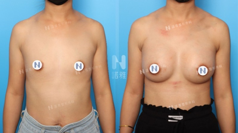 隆乳手術案例-隆乳前後變化差異對比