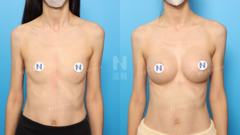 隆乳手術案例-隆乳術後恢復變化對照