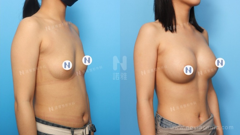 隆乳手術案例-手術效果視覺對比