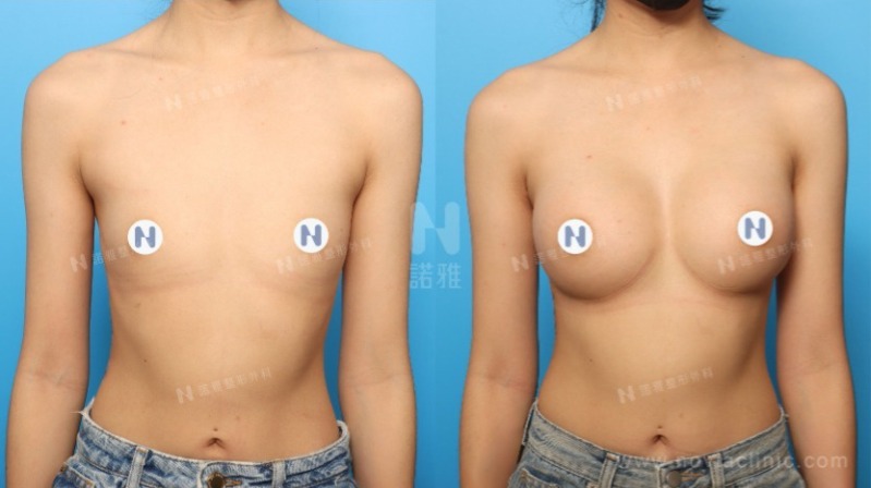 隆乳手術案例-隆乳手術前後外觀變化圖