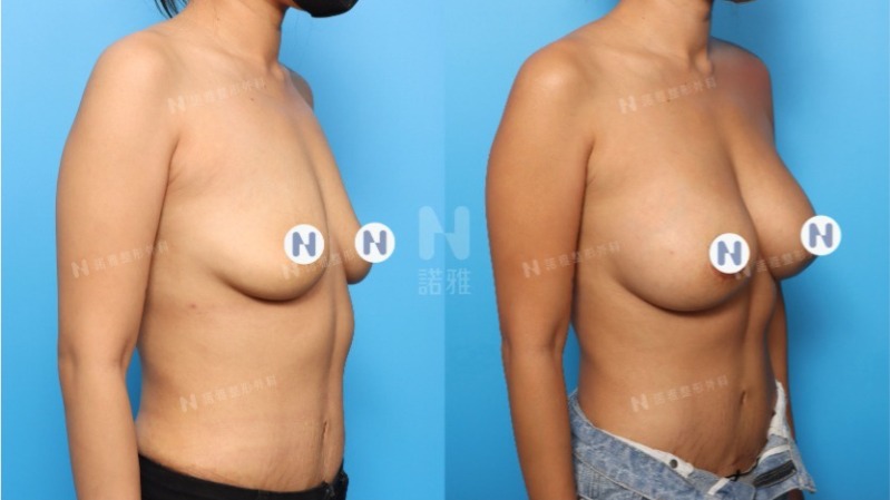 隆乳手術案例-隆乳效果前後對比