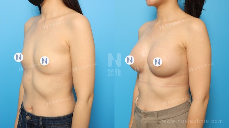 隆乳手術案例-隆乳術後形狀變化對比