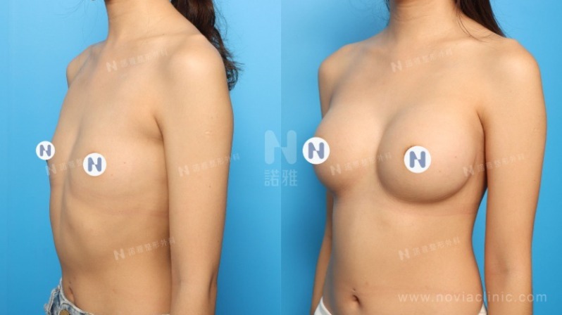 隆乳手術案例-隆乳結果前後差異