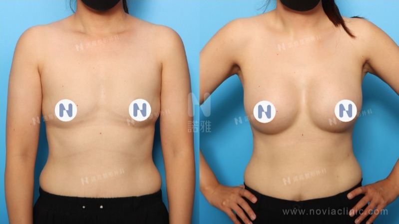 隆乳手術案例-手術效果與恢復情況對比