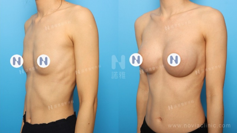 隆乳手術案例-術前術後外觀差異