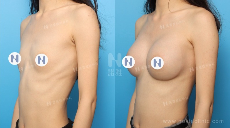 隆乳手術案例-隆乳術後結果對比