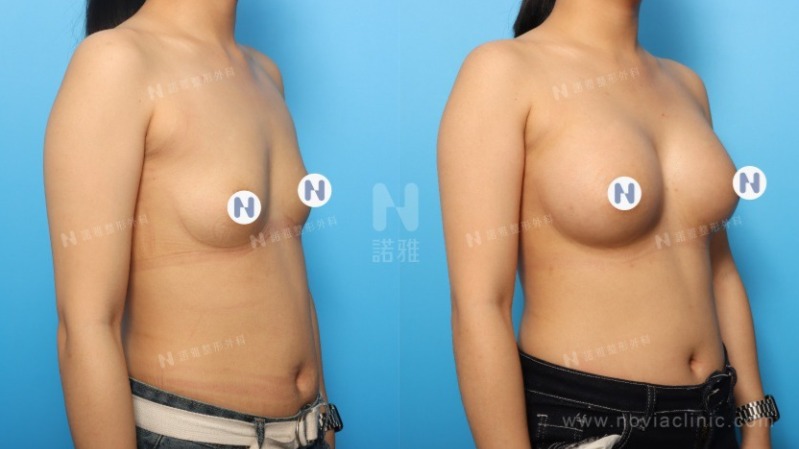 隆乳手術案例-術後恢復情況比較