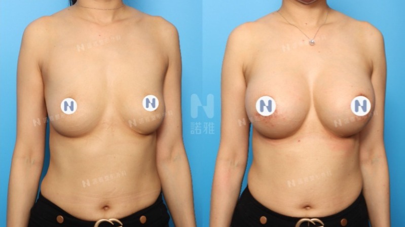 隆乳手術案例-手術前後外觀變化圖
