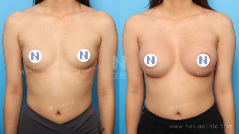 隆乳手術案例-手術後外觀變化圖