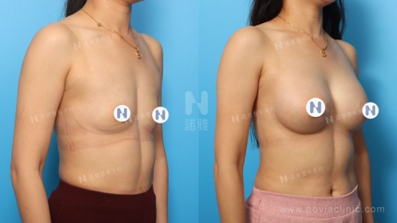 隆乳手術案例-隆乳術前術後變化分析