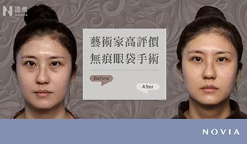 美麗見證✦無痕眼袋手術｜術後開窯大功告成，藝術家超滿意！｜洪敏翔醫師