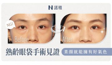 【輕熟齡】隱痕眼袋手術記錄！臉部凹陷一併處理！ ｜李昱恆醫師