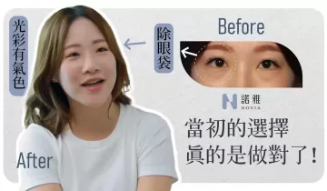 【無痕式眼袋見證】當初這個選擇，真的是做對了！