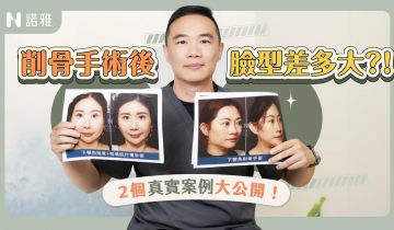 臉型可以差這麼多?!削骨手術後的真實變化太驚人!醫師卻語重心長說:不是每個臉大都要削骨?!許修銨醫師|諾雅整形外科